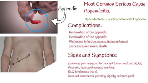 Large Intestine Pain Right Side | Bruin Blog