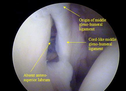 Glenohumeral Joint Anatomy, Stabilizer, and Biomechanics : 네이버 블로그