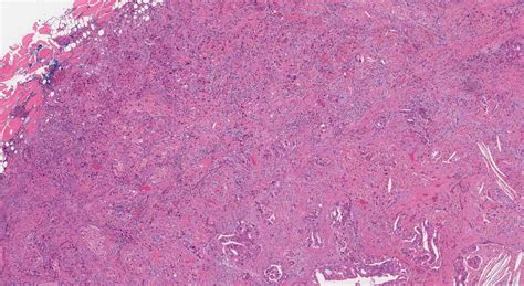 Salivary duct carcinoma | Ottawa Atlas of Pathology