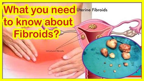 Fibroids: Types, Causes, and Symptoms | what you need to know about ...