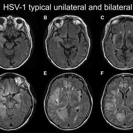 Schematic diagram of herpes simplex virus infection (adapted from C ...