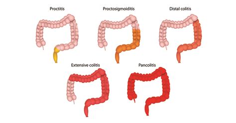 What is ulcerative colitis (UC) | Symptoms | Treatment