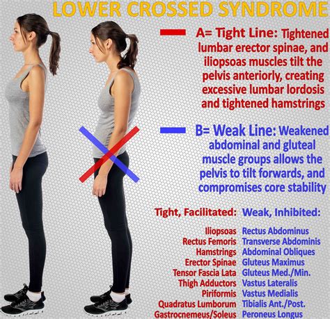 Lower crossed syndrome explained | Gluteal muscles, Abdominus rectus, Lumbar lordosis