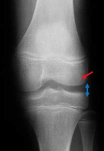 Causes of Discoid Meniscus | David Slattery