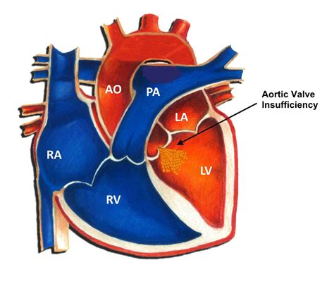 Aortic Valve Insufficiency - Pediatric Heart Specialists