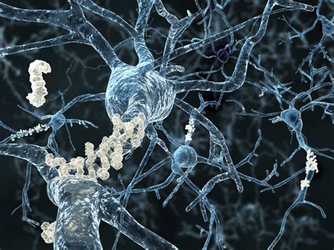 Brain plaque buildup tied to Alzheimer's found in young adults - CBS News