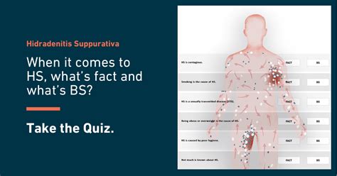 What is Hidradenitis Suppurativa (HS)? | No BS About HS