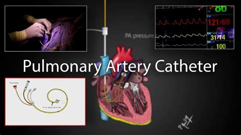 Pulmonary artery catheter (Swan-Ganz Catheter) placement and physiology