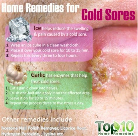 Cold sores remedy Home Remedies Cold Sores, Home Remedies For Herpes ...