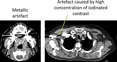 Beam Hardening Artifact In Ct - The Best Picture Of Beam