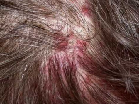 Sores on Scalp, Scabs, Itchy, Painful, Pictures, Crusty, Pimples on Scalp, Acne… | Scalp scabs ...