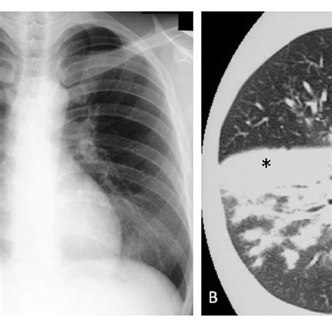 | Mycoplasma pneumoniae pneumonia in human. (A) Chest x-ray shows ...