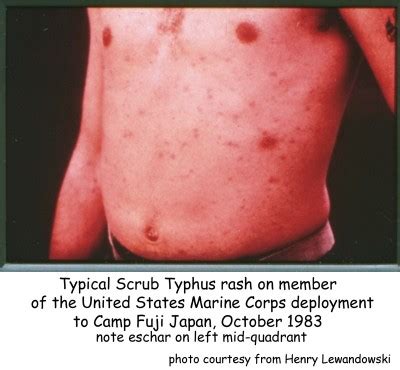 Scrub Typhus Rash