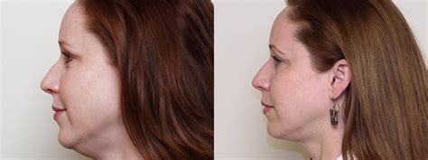 Neck Lift (Submentoplasty) Before and After Photo Gallery | Atlanta ...