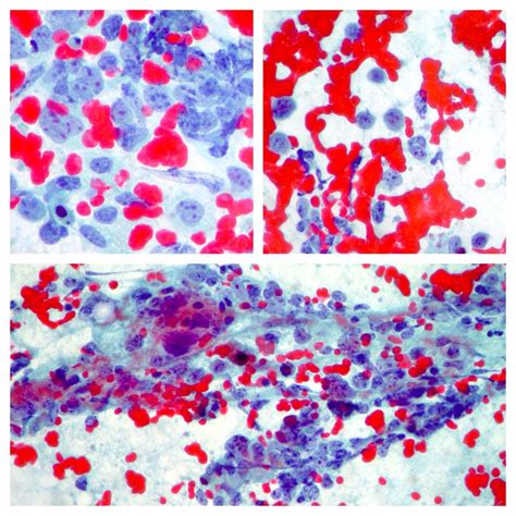 Cytopathology of lymph nodes-FNAC – Cellnetpathology.com