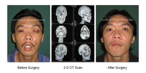 Craniofacial Trauma Reconstruction – MSPRS