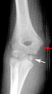 Clinical Practice Guidelines : Medial epicondyle fracture of the humerus - Emergency Department