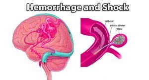 Hemorrhage And Shock - Types - Steps - Causes - Sign & Symptoms ...