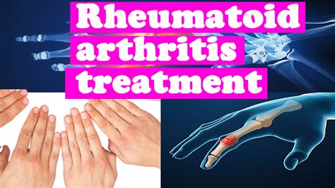 Rheumatoid Arthritis - Home Remedies for Rheumatoid Arthritis ...