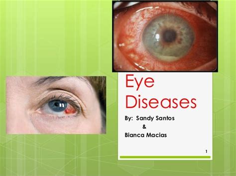 Eye diseases