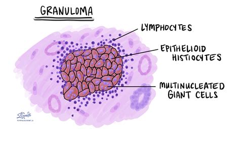 Granuloma | I-MyPathologyReport.ca