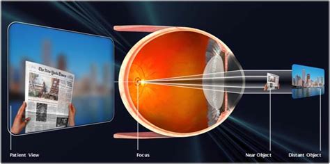 Nearsightedness Treatment Los Angeles & Monterey Park