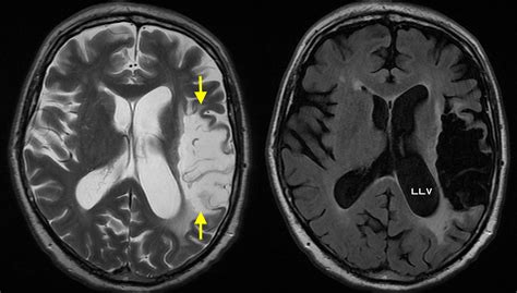 Encephalomalacia due to old MCA infarct - Radiology at St. Vincent's ...