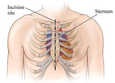 Sternum Clicking & Shoulder Pain After Heart Surgery - For Patients