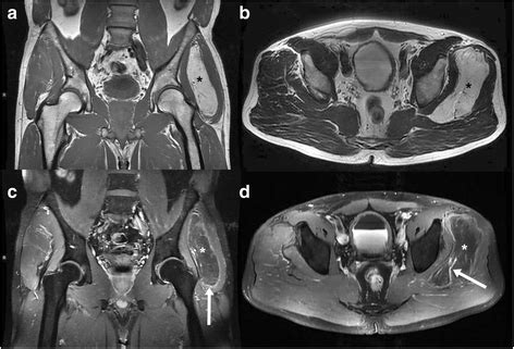 Hibernoma – two patients with a rare lipoid soft-tissue tumour | BMC Medical Imaging | Full Text