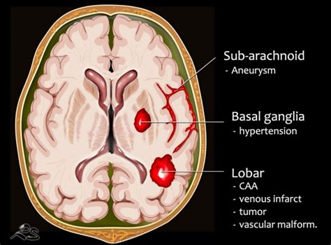 Traumatic Subarachnoid Hemorrhage