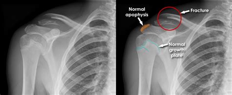 Clavicle Bone X Ray