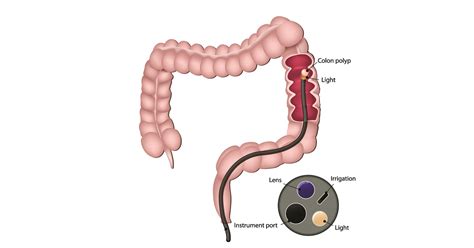 Sigmoidoscopy: Purpose, Preparation, Procedure & Aftercare