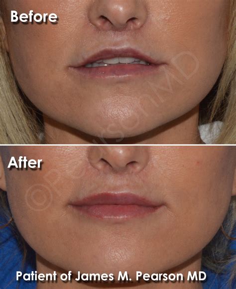 Lip Lift Photos - Before & After - Dr. James Pearson Facial Plastic Surgery