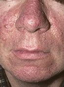 Neurocutaneous Disorders: Tuberous Sclerosis Complex and Sturge-Weber Syndrome