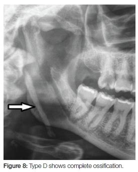 Styloid Process X Ray