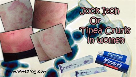 Jock itch or Tinea cruris in women, causes and treatment - WivesMag