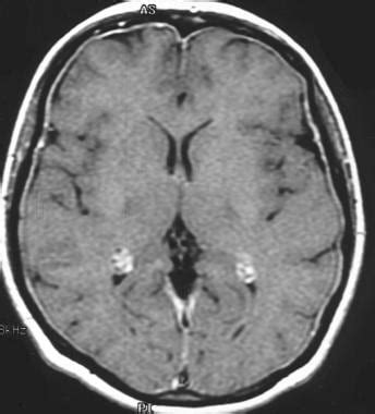 Bacterial Meningitis Imaging: Practice Essentials, Computed Tomography ...