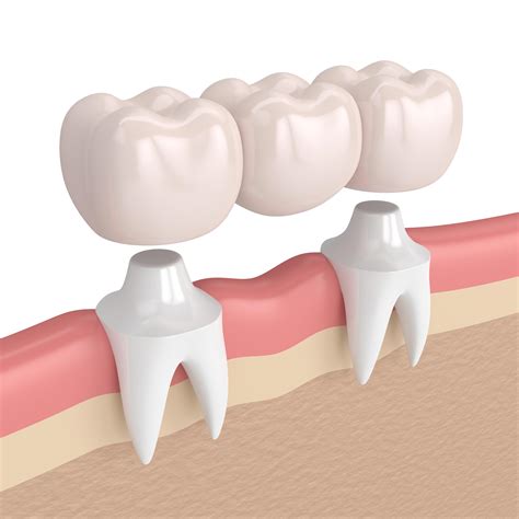 Dental Bridge | Tooth Crowns & Bridges Auckland | CM Dental