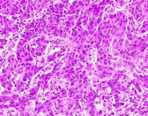 Pathology Outlines - Medullary carcinoma