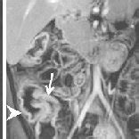 (PDF) Intestinal tuberculosis versus Crohn's disease: Clinical and radiological recommendations