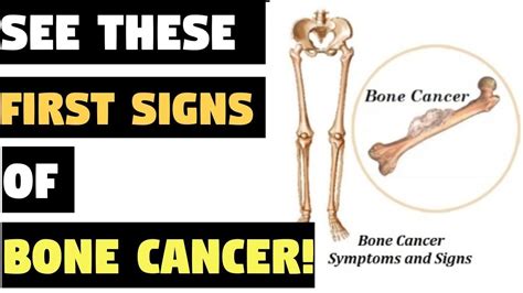 Symptoms Of Bone Cancer In Shoulder - Bone Tumor: Types, Causes, and ...