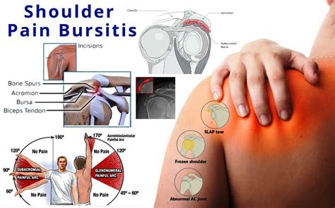 Shoulder Pain Bursitis Homeopathy Treatment,Medicines for Bursitis Pain in Shoulder