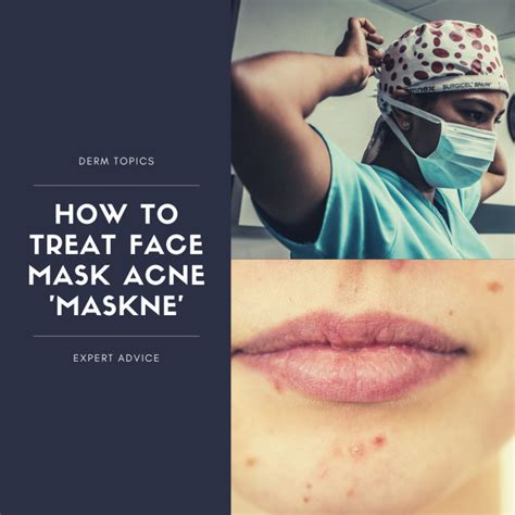 How to Treat Face Mask Acne 'Maskne' - Next Steps in Dermatology