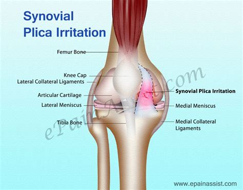 Synovial Plica | Etiology | Plica Snap | Leg presses | Knee Exercise | Leg