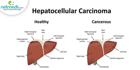 Hepatocellular Carcinoma: Causes, Symptoms And Treatment