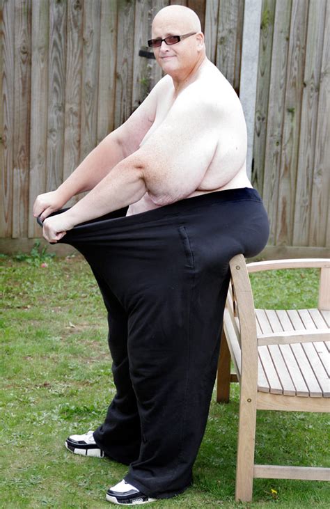 World’s Fattest Man Loses 285 Kg But Now Requires Operation To Get Rid Of Sagging Skin