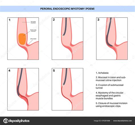 Peroral Endoscopic Myotomy Poem Minimally Invasive Procedure Disorder Esophagus Achalasia Stock ...