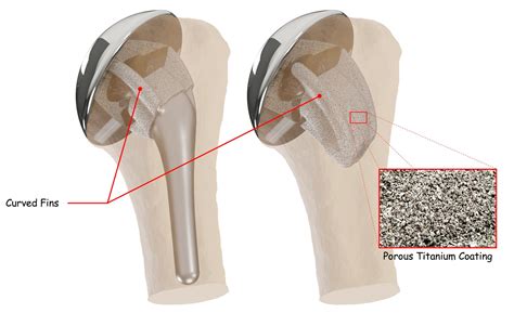 Total Shoulder Replacement Surgery - Shoulder Innovations