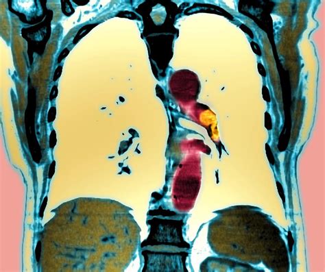 Pulmonary Embolism, Ct Scan Photograph by Du Cane Medical Imaging Ltd