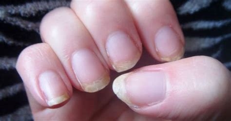 Causes of brittle nails - Awesome Nail